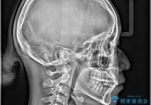 非抜歯矯正で八重歯を改善|短期間8か月で美しい歯並びに|インビザラインライト上顎のみで矯正の治療後
