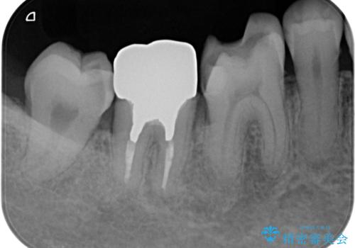 歯周ポケットの除去を併用したセラミック治療の治療前