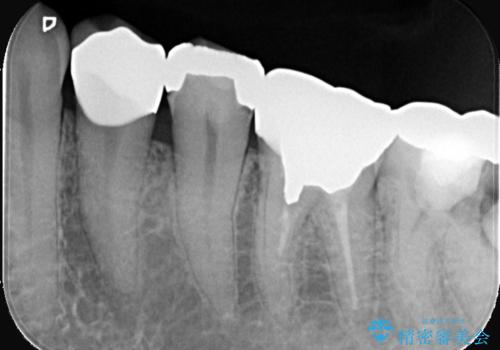 神経を抜かずに深い虫歯を治療の治療後