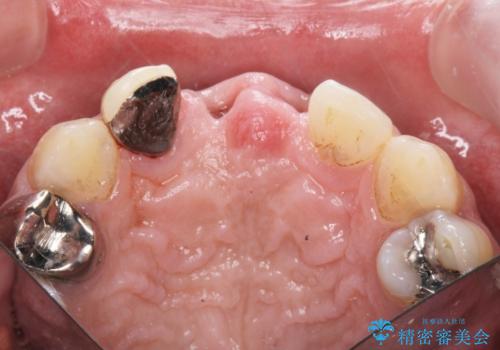 [ 前歯セラミックブリッジ治療 ]  転んで抜けた前歯 、見た目をきれいにしたいの治療中