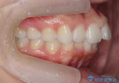 前歯のがたつき気になる。インビザラインモデレートの治療前