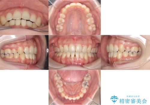 口ボコと歯のデコボコが気になる!|前歯が出ていて口が閉じにくい|審美ワイヤー矯正による口元の改善!の治療後