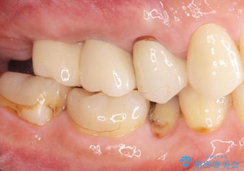 欠損した奥歯 インプラント補綴の治療後