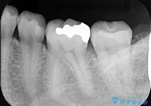 虫歯 〈セラミックインレー〉の治療後