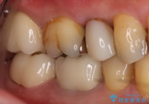 奥歯が痛む オールセラミッククラウンの治療後