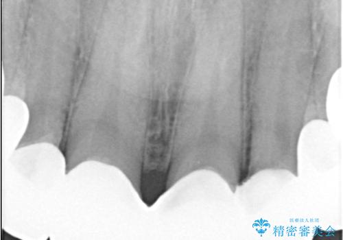 前歯のクラウンをやり変え、歯肉のラインも美しくの治療前