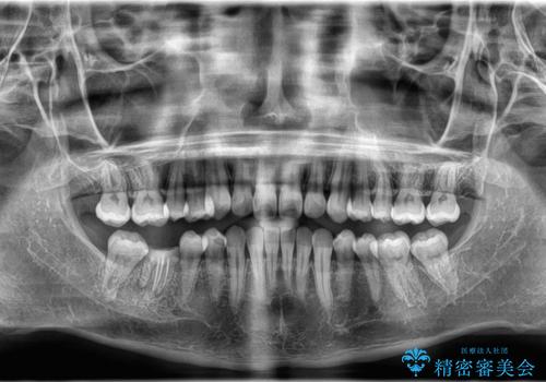 非抜歯矯正で八重歯を改善|短期間8か月で美しい歯並びに|インビザラインライト上顎のみで矯正の治療後