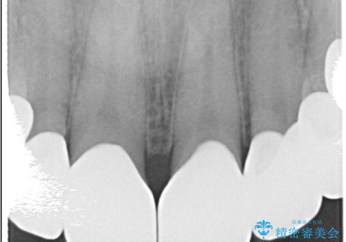前歯のクラウンをやり変え、歯肉のラインも美しくの治療後