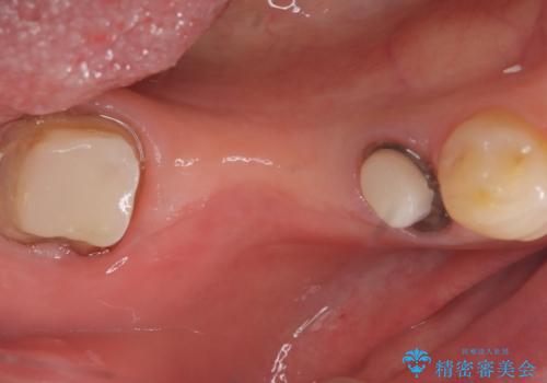 【ゴールドクラウン】セラミックのブリッジが何度も壊れるの治療中