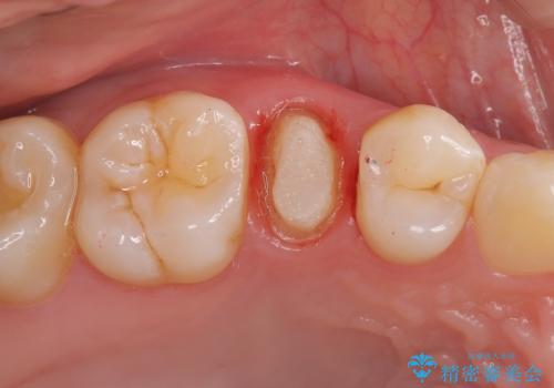 【根管治療】【セラミッククラウン】根っこが細くて治療できないと言われたの治療中