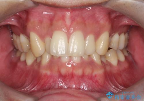 前歯のデコボコと深い咬み合わせを解消の治療前