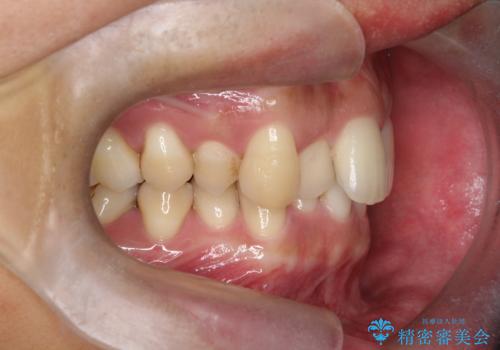 前歯のデコボコと深い咬み合わせを解消の治療前