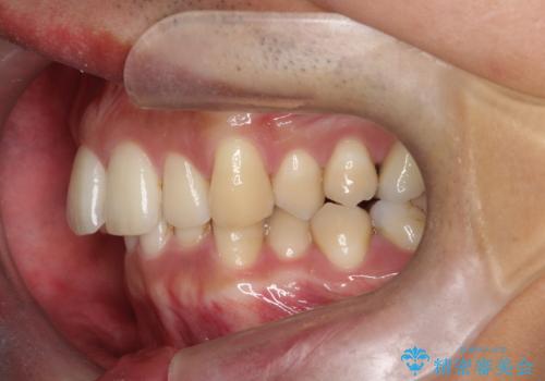 前歯のデコボコと深い咬み合わせを解消の治療前