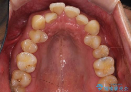 前歯のデコボコと深い咬み合わせを解消の治療前