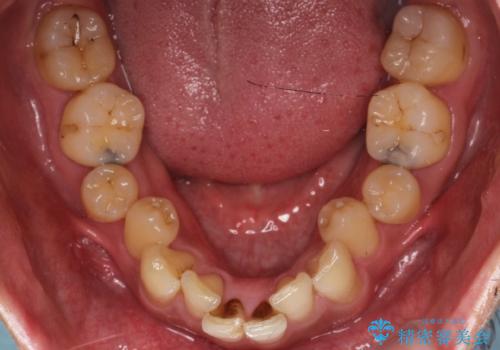 前歯のデコボコと深い咬み合わせを解消の治療前