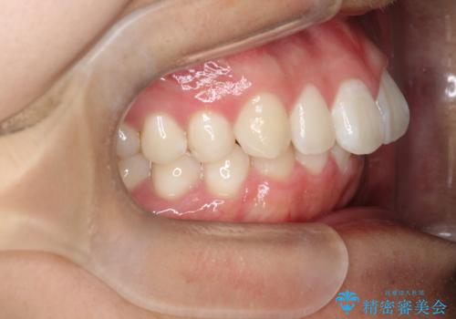 必ずしもワイヤーでなくても大丈夫!インビザラインでデコボコ歯列&過蓋咬合を改善の治療前