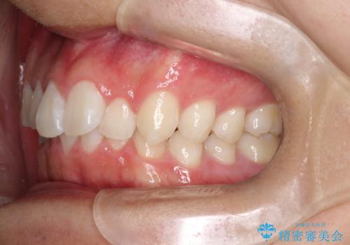 必ずしもワイヤーでなくても大丈夫!インビザラインでデコボコ歯列&過蓋咬合を改善の治療前