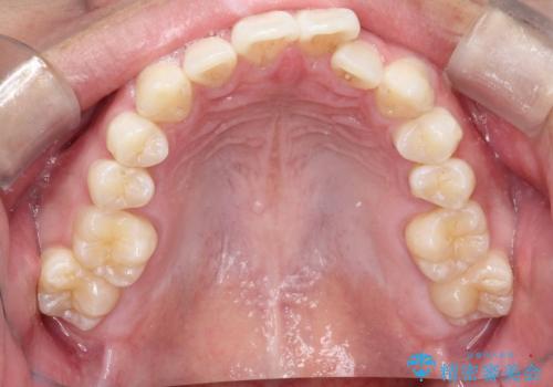 必ずしもワイヤーでなくても大丈夫!インビザラインでデコボコ歯列&過蓋咬合を改善の治療前