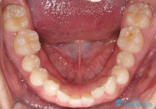 必ずしもワイヤーでなくても大丈夫!インビザラインでデコボコ歯列&過蓋咬合を改善の治療前