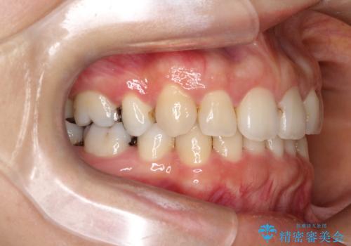 歯の中心のズレを解消し、より美しい口元への治療前