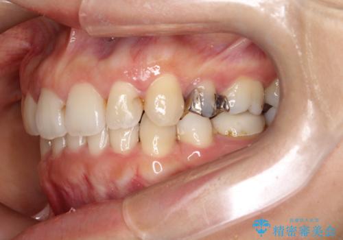 歯の中心のズレを解消し、より美しい口元への治療前