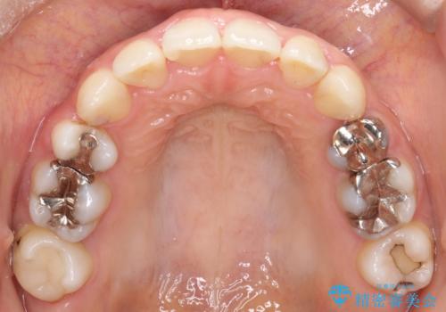 歯の中心のズレを解消し、より美しい口元への治療前