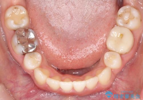 歯の中心のズレを解消し、より美しい口元への治療前