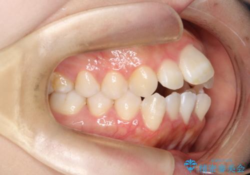 前歯のデコボコと開口を改善し、美しい口元への治療前