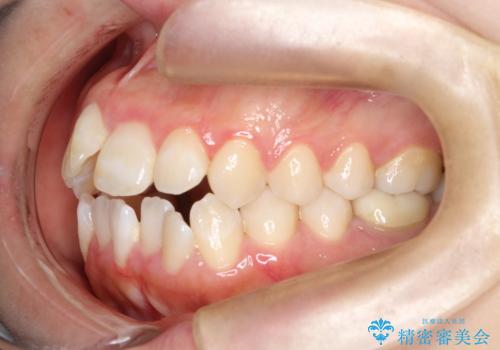 前歯のデコボコと開口を改善し、美しい口元への治療前