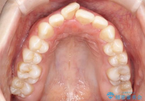 前歯のデコボコと開口を改善し、美しい口元への治療前