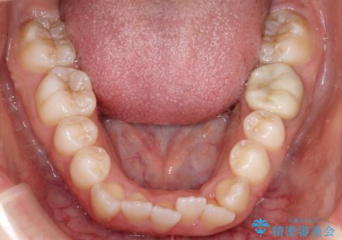 前歯のデコボコと開口を改善し、美しい口元への治療前