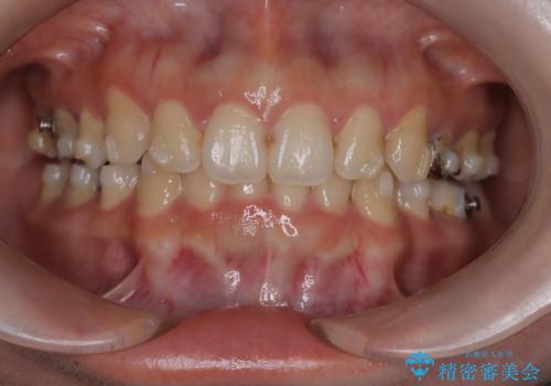 歯の中心のズレを解消し、より美しい口元への治療中