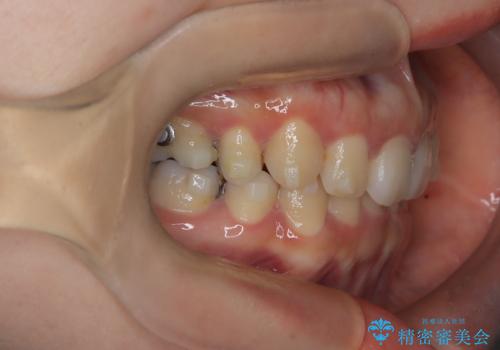 歯の中心のズレを解消し、より美しい口元への治療中