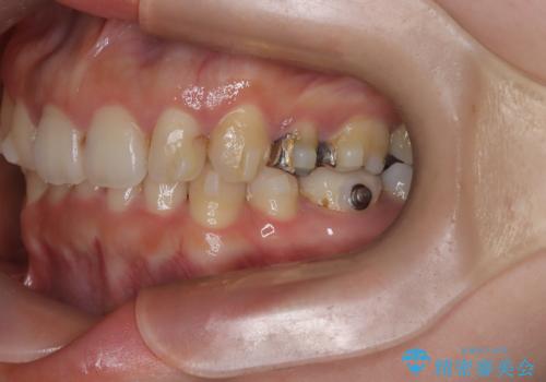 歯の中心のズレを解消し、より美しい口元への治療中