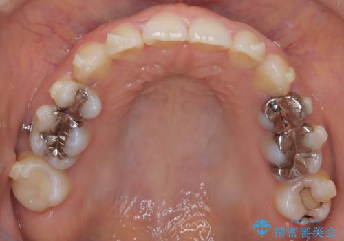 歯の中心のズレを解消し、より美しい口元への治療中