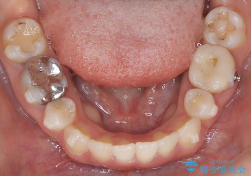 歯の中心のズレを解消し、より美しい口元への治療中