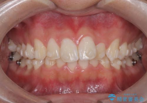 必ずしもワイヤーでなくても大丈夫!インビザラインでデコボコ歯列&過蓋咬合を改善の治療中