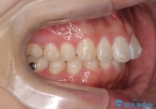 必ずしもワイヤーでなくても大丈夫!インビザラインでデコボコ歯列&過蓋咬合を改善の治療中