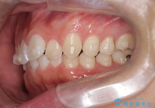 必ずしもワイヤーでなくても大丈夫!インビザラインでデコボコ歯列&過蓋咬合を改善の治療中