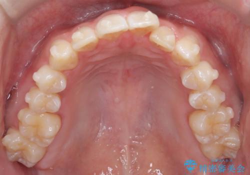 必ずしもワイヤーでなくても大丈夫!インビザラインでデコボコ歯列&過蓋咬合を改善の治療中