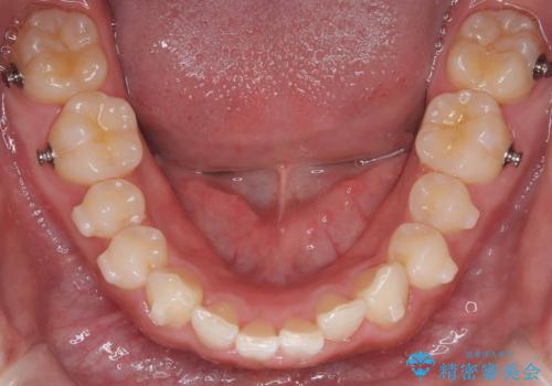 必ずしもワイヤーでなくても大丈夫!インビザラインでデコボコ歯列&過蓋咬合を改善の治療中