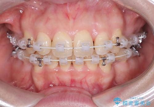 口ボコと歯のデコボコが気になる!|前歯が出ていて口が閉じにくい|審美ワイヤー矯正による口元の改善!の治療中