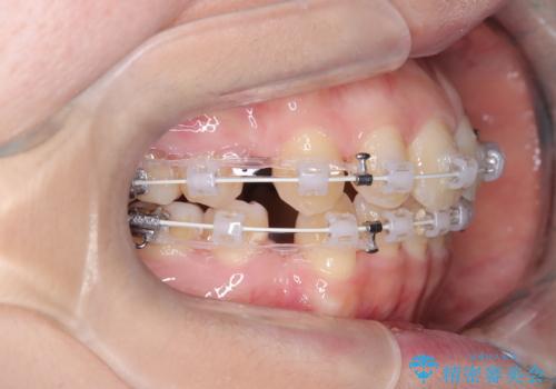 口ボコと歯のデコボコが気になる!|前歯が出ていて口が閉じにくい|審美ワイヤー矯正による口元の改善!の治療中