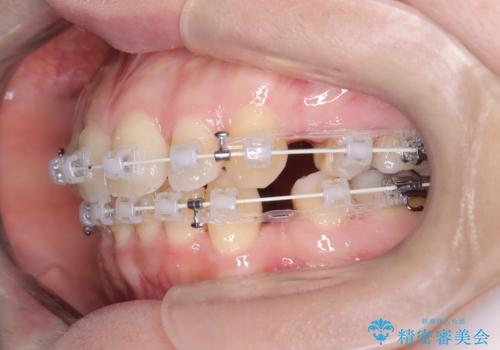 口ボコと歯のデコボコが気になる!|前歯が出ていて口が閉じにくい|審美ワイヤー矯正による口元の改善!の治療中