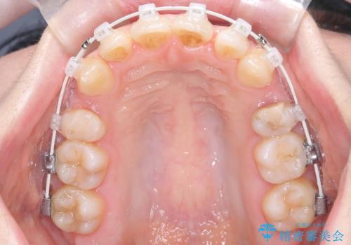 口ボコと歯のデコボコが気になる!|前歯が出ていて口が閉じにくい|審美ワイヤー矯正による口元の改善!の治療中