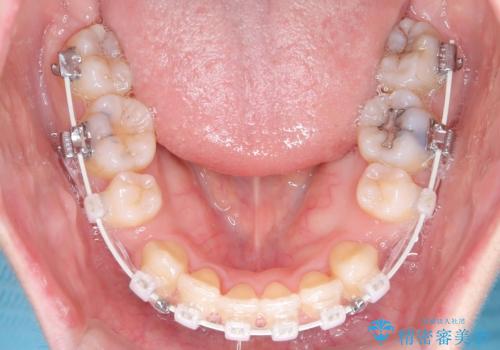 口ボコと歯のデコボコが気になる!|前歯が出ていて口が閉じにくい|審美ワイヤー矯正による口元の改善!の治療中