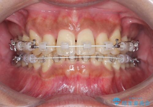 前歯のデコボコと深い咬み合わせを解消の治療中