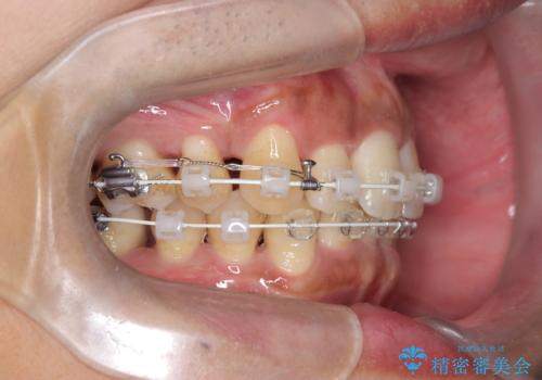 前歯のデコボコと深い咬み合わせを解消の治療中