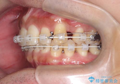 前歯のデコボコと深い咬み合わせを解消の治療中