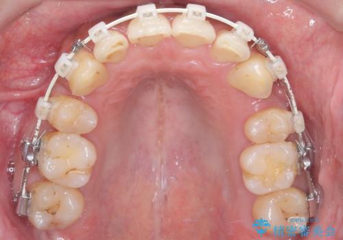前歯のデコボコと深い咬み合わせを解消の治療中